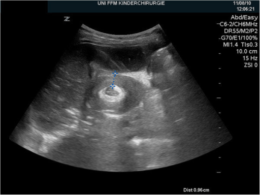 Ultrassonografia do quadrante abdominal superior direito