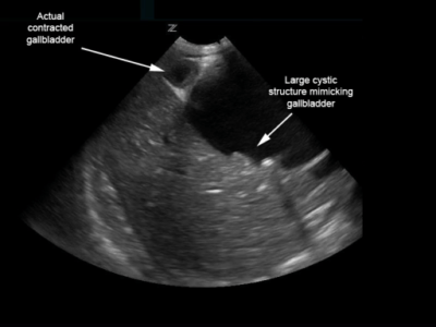 Cholestasis in Neonates and Young Infants | Concise Medical Knowledge