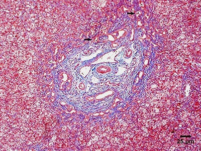 Photomicrograph showing the main histological findings of biliary atresia