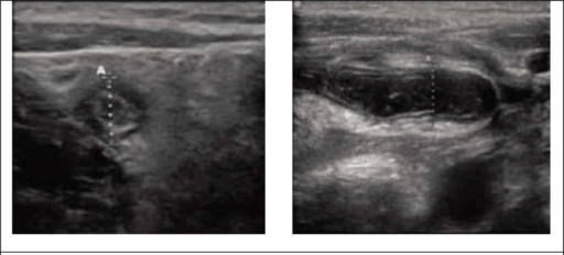 Visualizações ultrassonográficas do apêndice