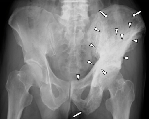 Paget's Disease of Bone | Concise Medical Knowledge