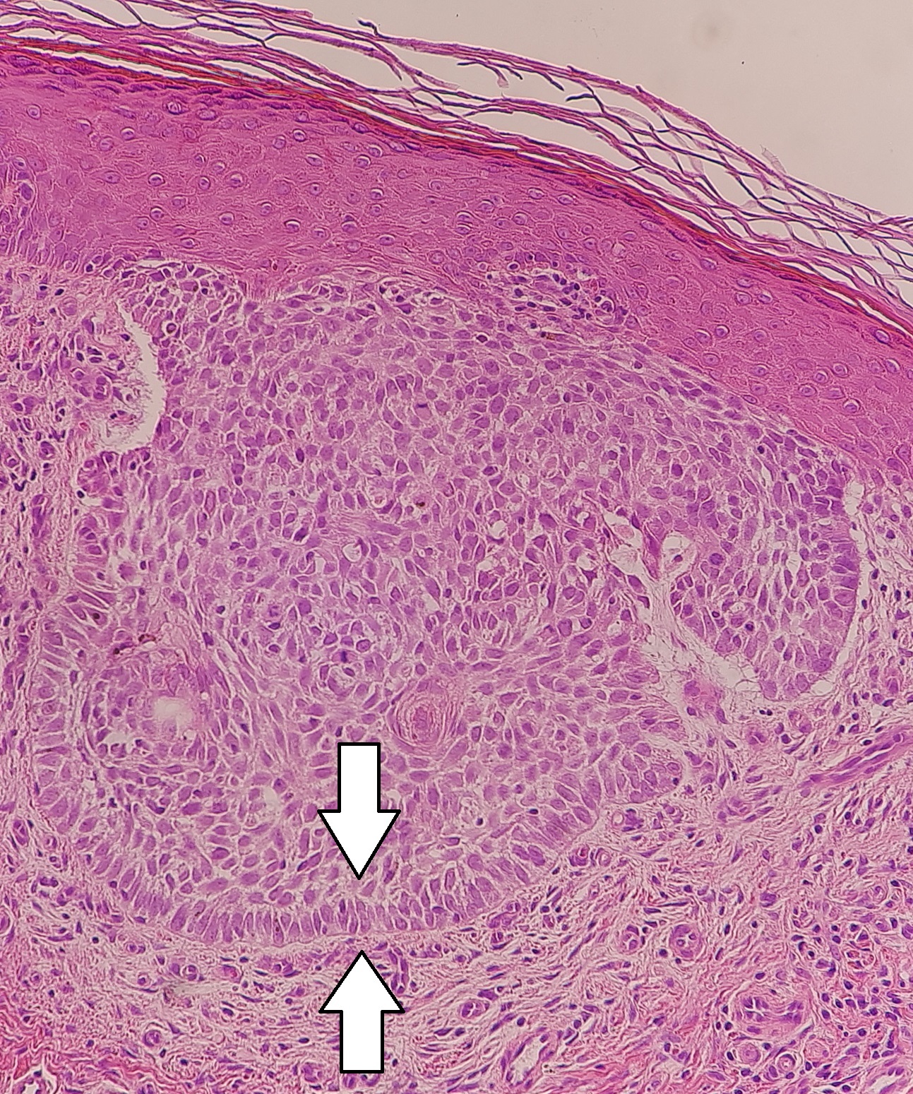 Palisading of keratinocytes in nodular basal cell cancer