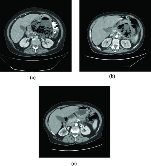 Pancreatic necrosis and gas in the retroperitoneum