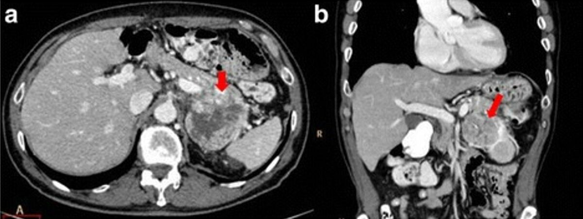 Pancreatic adenocarcinoma of the tail ct scans