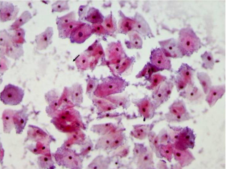 Frotis de papanicolaou que muestra vaginosis bacteriana con muchas células guía