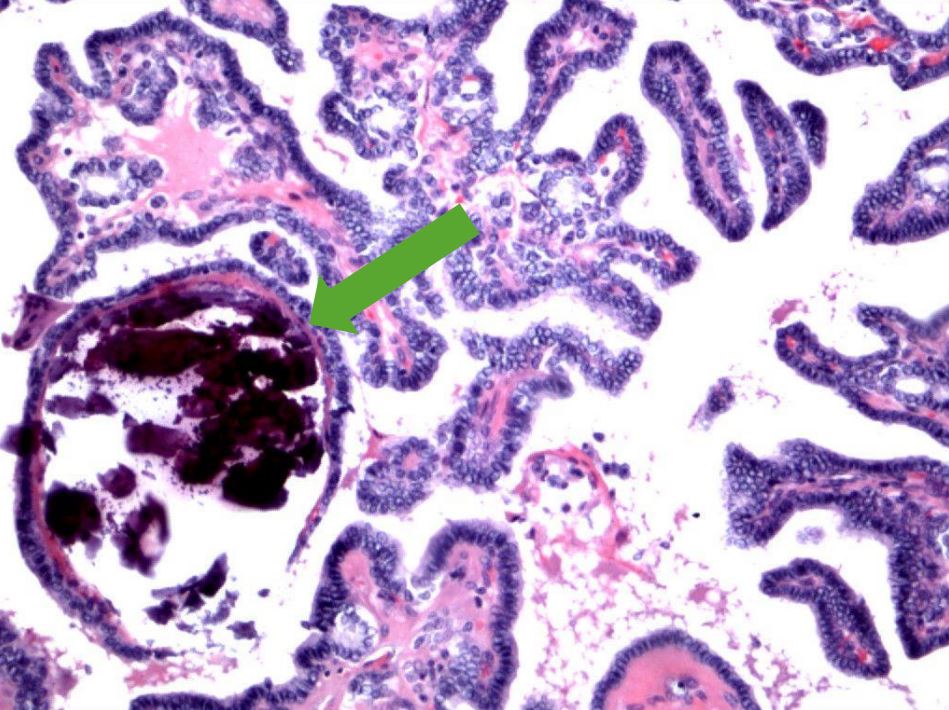 Papillary thyroid carcinoma