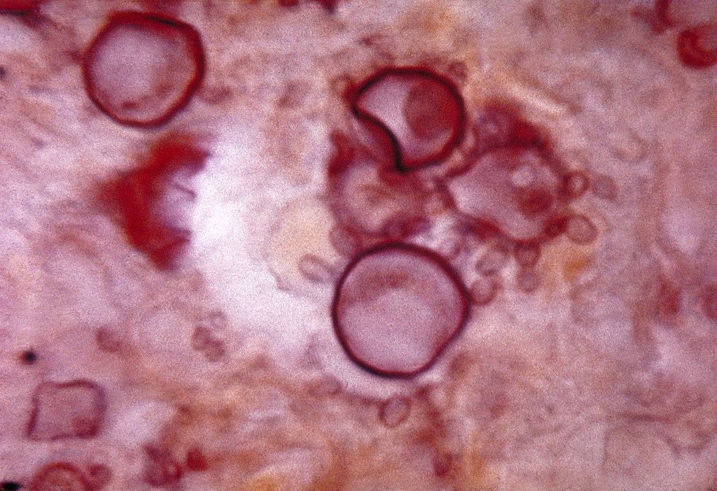 Paracoccidioidomycosis