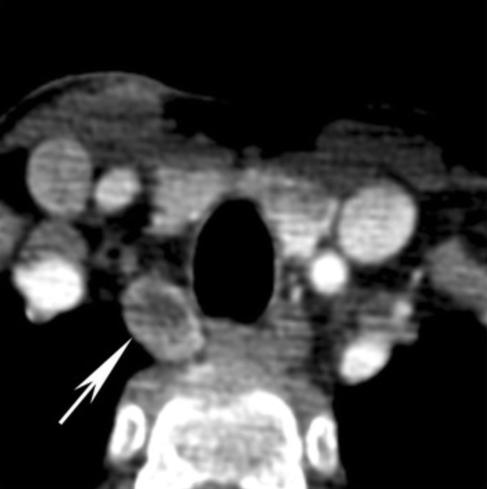 Parathyroid adenoma with cystic internal change