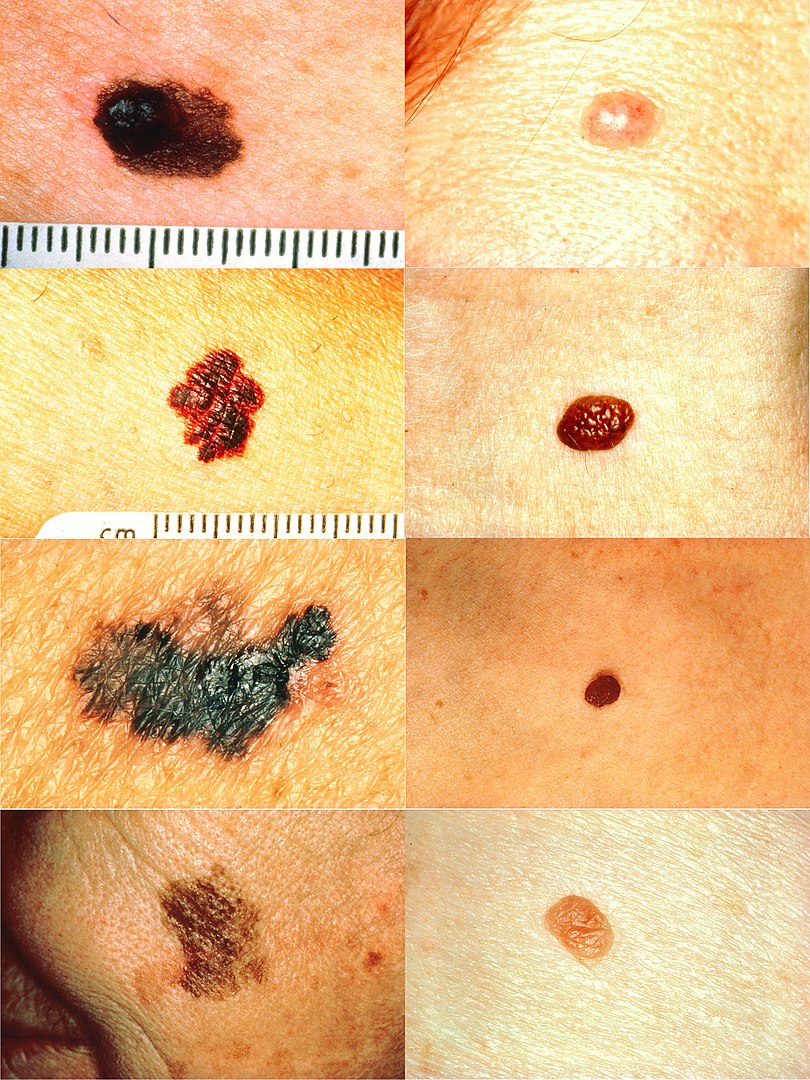 Melanoma Concise Medical Knowledge 8943