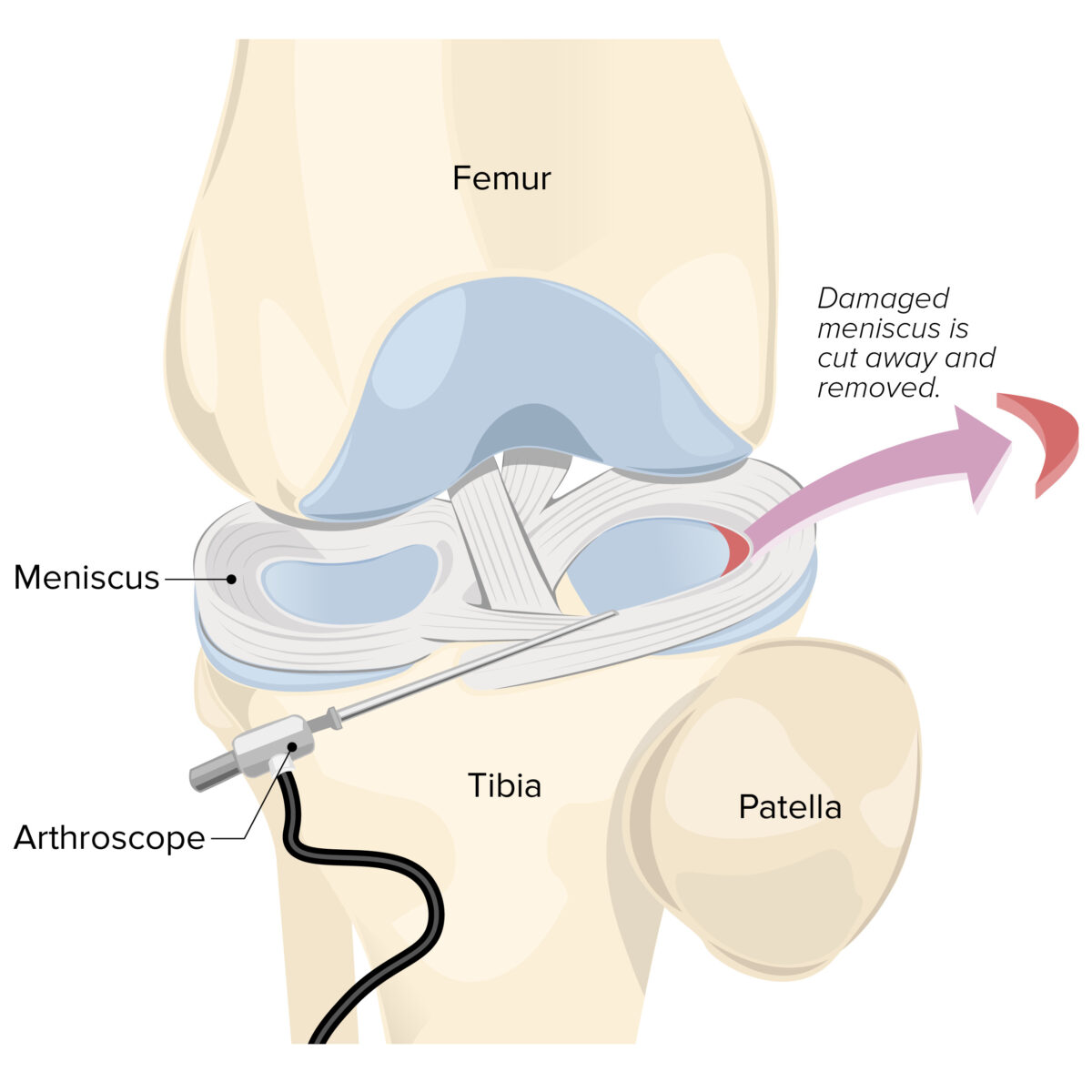 Knee arthroscopy with meniscectomy