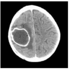 MRI of a brain abscess showing the classic “ring enhanced” lesion