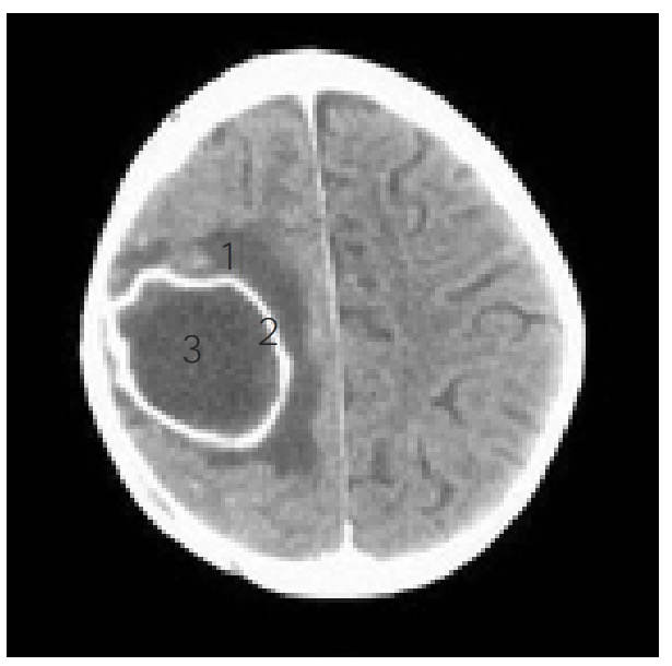 Ct of a brain abscess showing the classic “ring enhanced” lesion