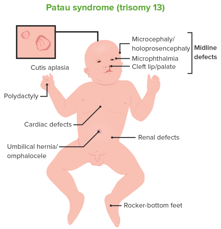 hsc-425-down-patau-edwards-syndrome-youtube