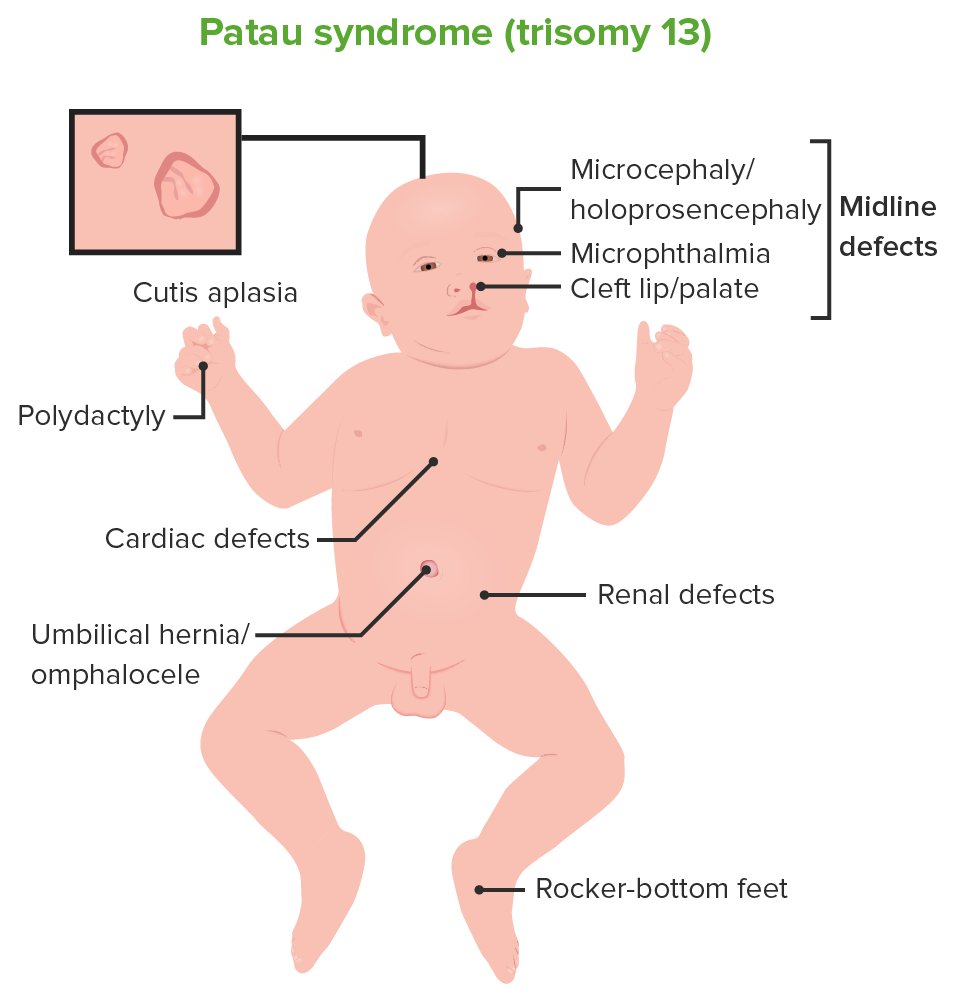 Patau syndrome (trisomy 13)
