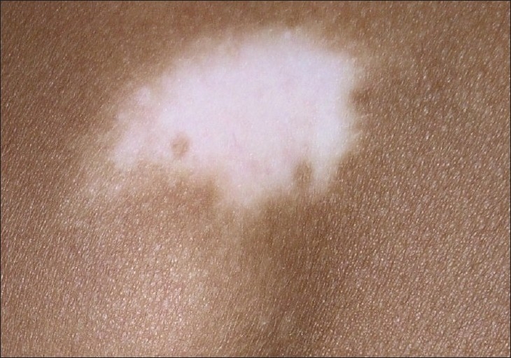Patch of vitiligo