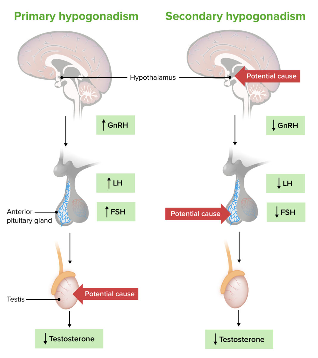 Pathogenesis of primary versus secondary hypogonadism