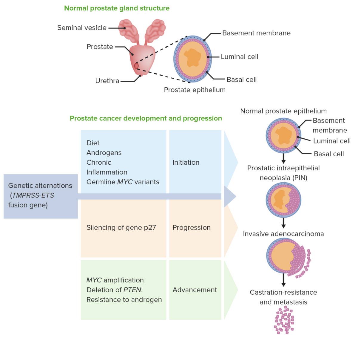 Pathogenesis of prostate cancer