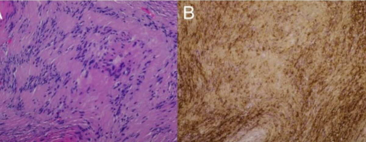 Pathology slides demonstrating schwannoma