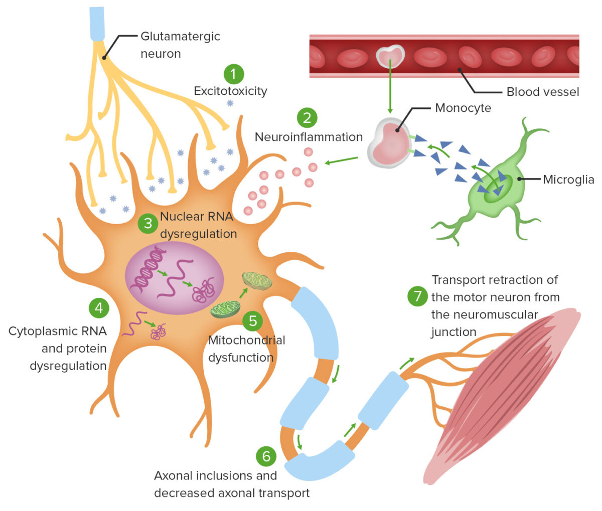 Esclerosis Lateral Amiotr Fica Concise Medical Knowledge   Pathophysiologic Mechanism Of ALS 1200x1019 