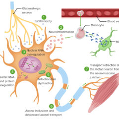 Pathophysiologic mechanism of ALS