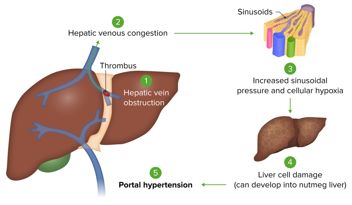 Pathophysiology budd-chiari syndrome