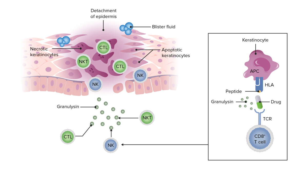 Fisiopatología del síndrome de stevens-johnson y de la necrólisis epidérmica tóxica