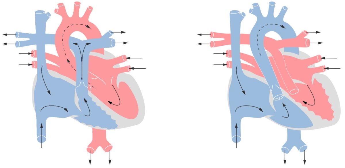 Pathophysiology of Tetralogy of Fallot