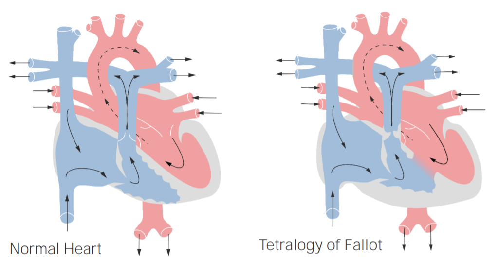 Pathophysiology of tetralogy of fallot