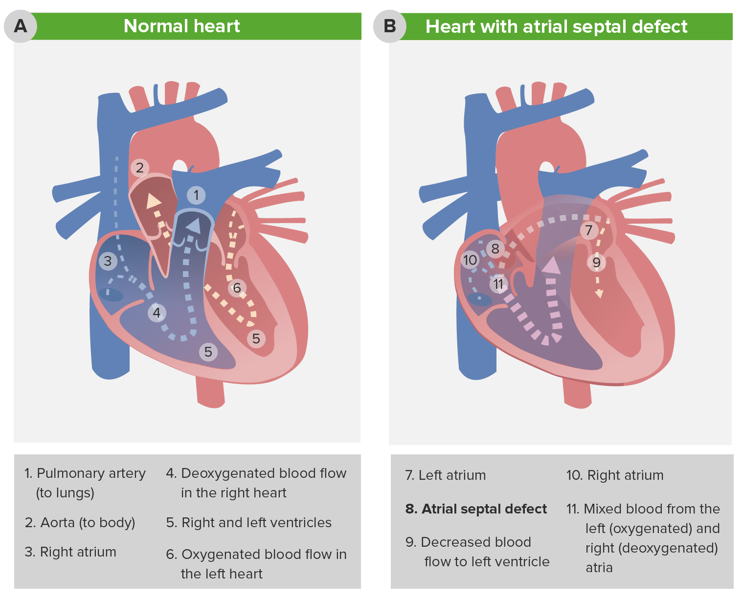 atrial septal defect types