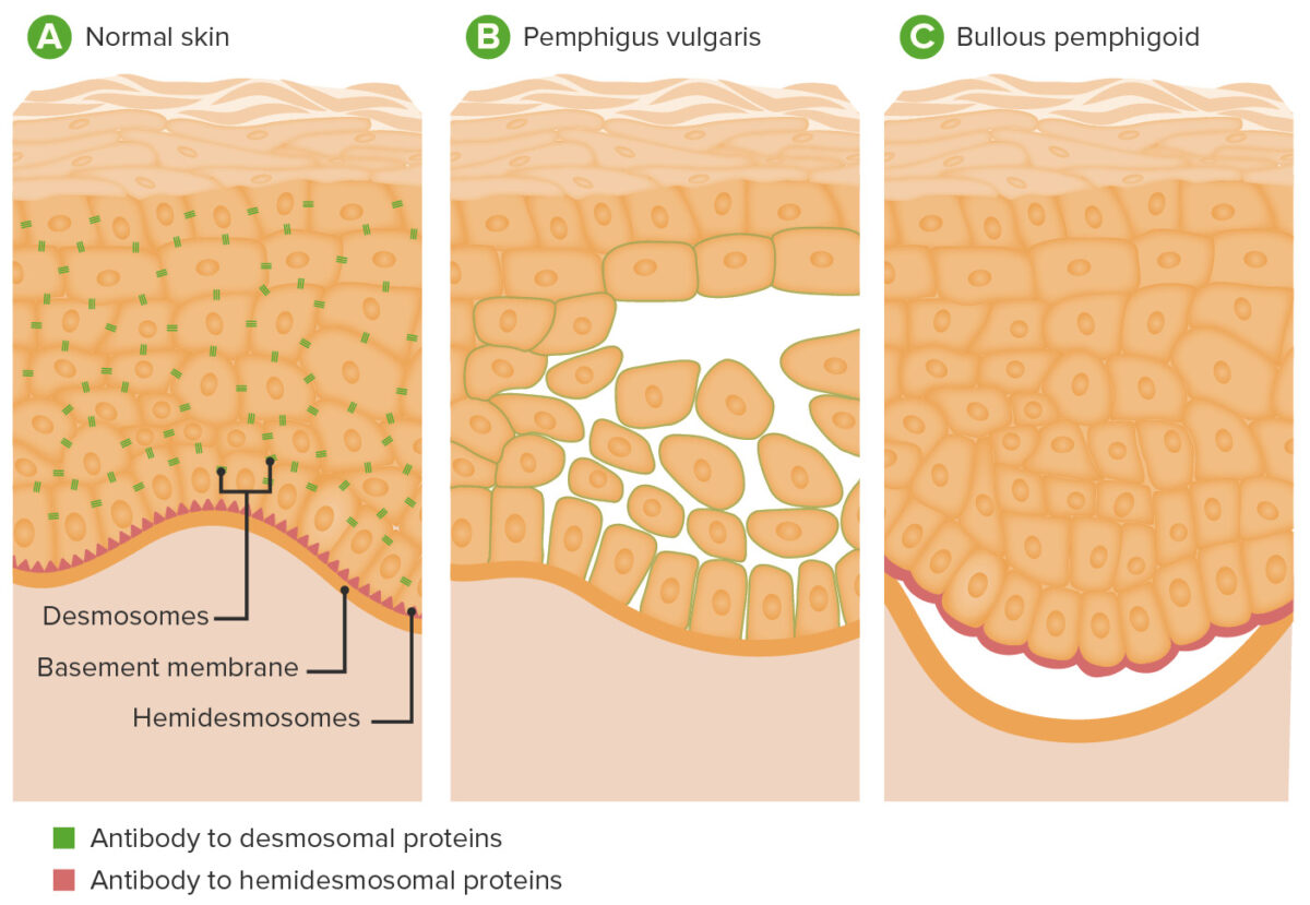 Fisiopatologia do pênfigo vulgar e penfigoide bolhoso