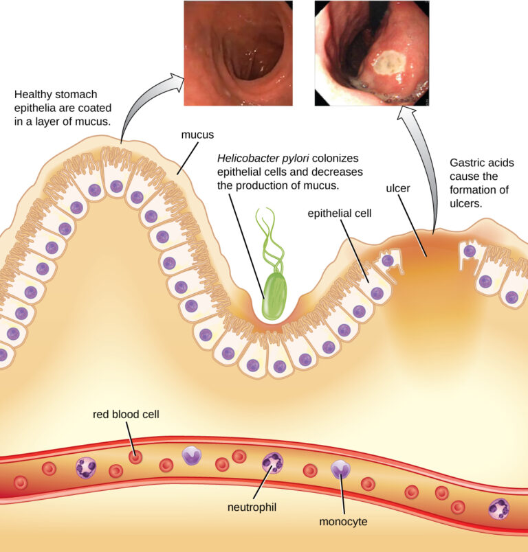 Peptic Ulcer Disease Concise Medical Knowledge