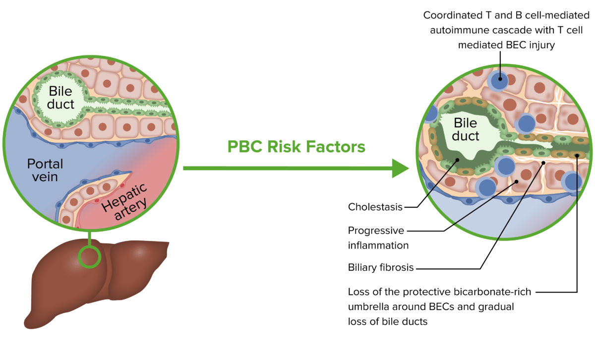 Pathophysiology of primary biliary cholangitis (pbc)