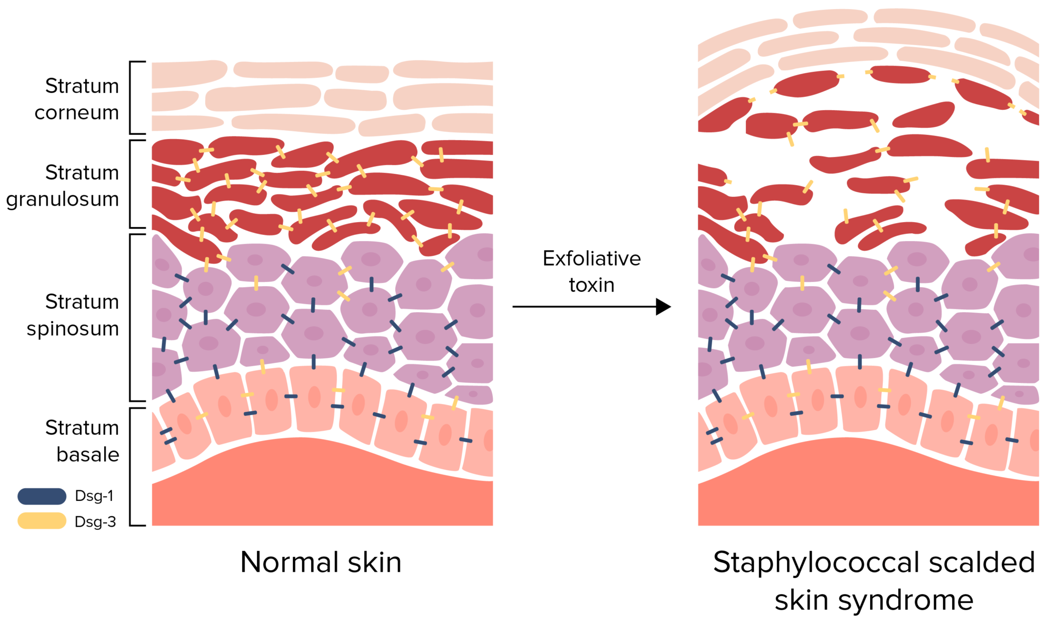Staphylococcal Scalded Skin Syndrome SSSS Concise Medical Knowledge