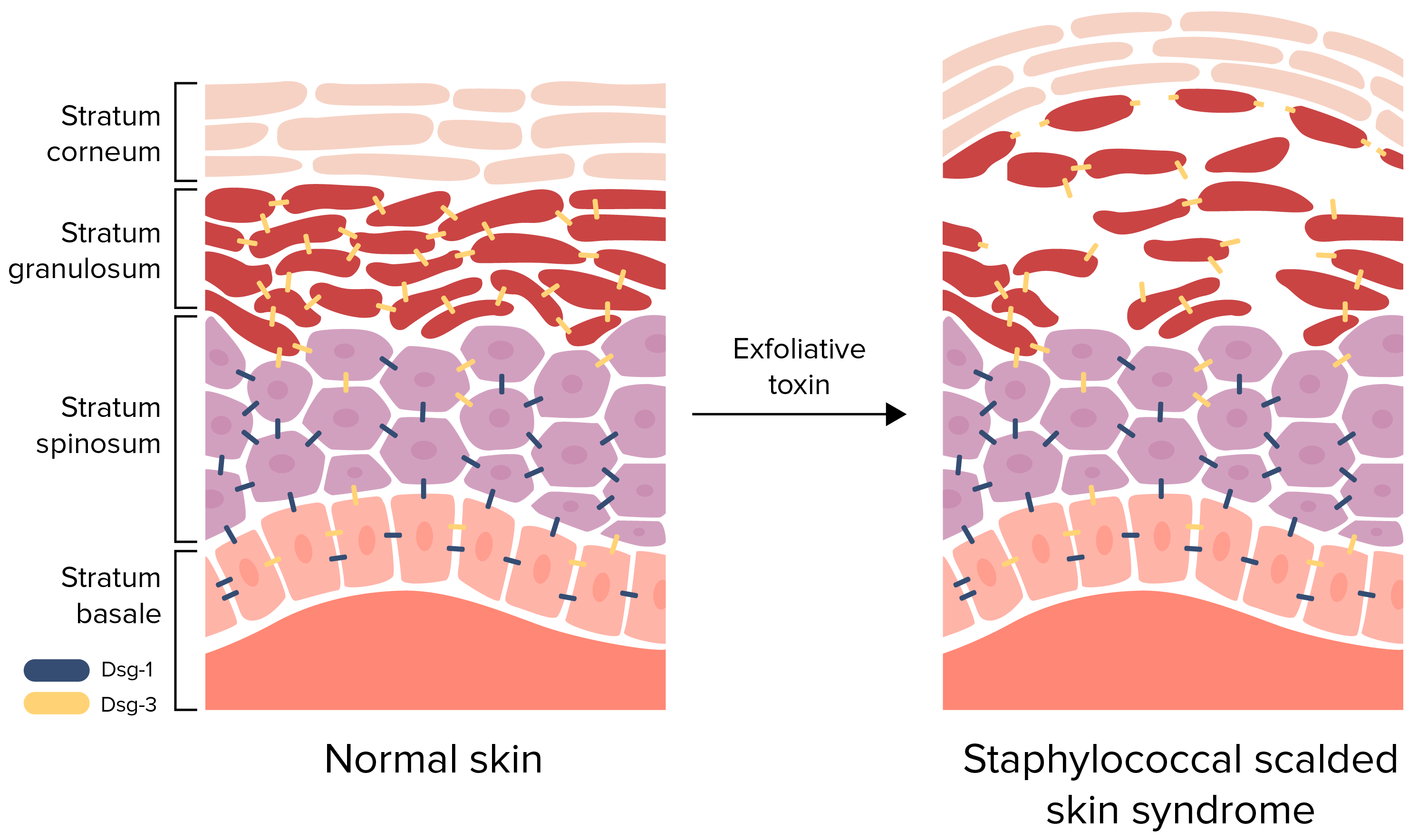 Staphylococcal Scalded Skin Syndrome Ssss Concise Medical Knowledge