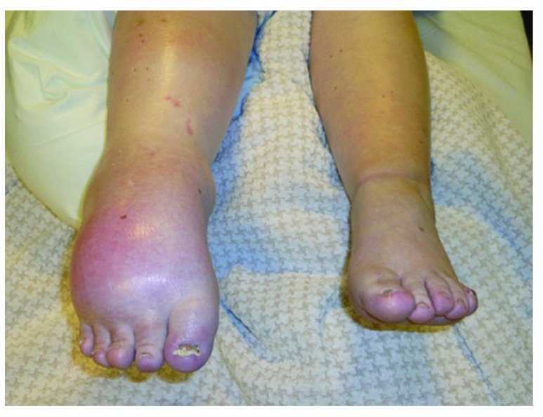 Complex regional pain syndrome type 1 (crps-1)