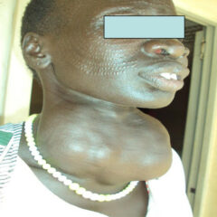 Patient from South Sudan with a goiter