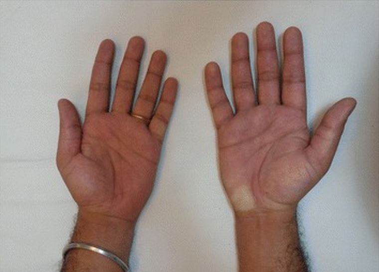 Complex regional pain syndrome, presenting with a swollen right hand