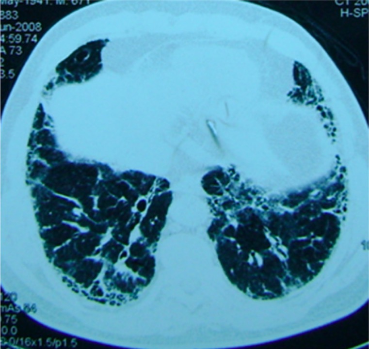 Paciente con fibrosis pulmonar