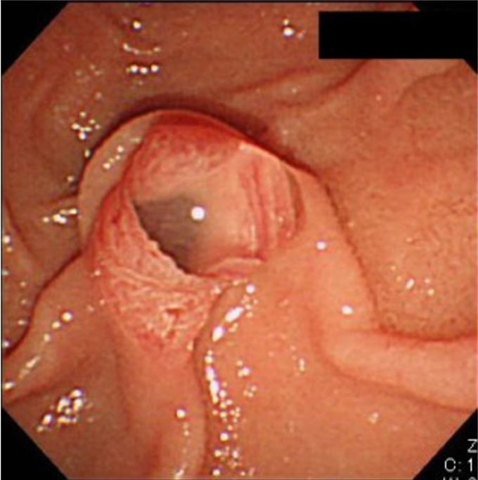 Patulous orifice of a dilated papilla with a protrusion of thick mucus