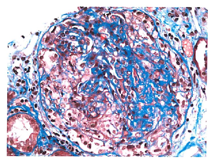 Pauci-immune crescentic glomerulonephritis showing fibrin occurring within the cellular crescents