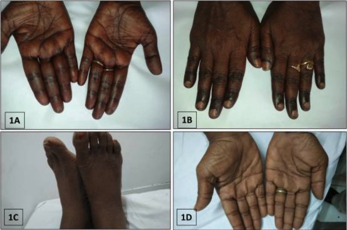Peculiar cutaneous hyperpigmentation from cases with megaloblastic anemia