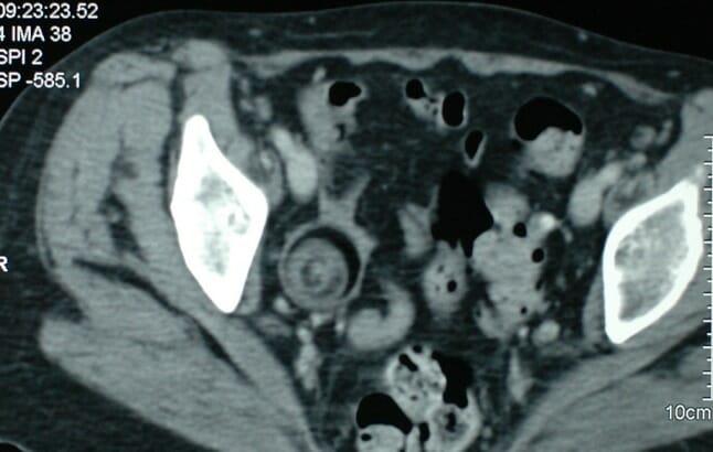 Pelvic ct showing dermoid cyst of the ovary