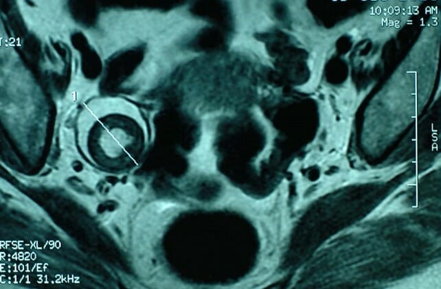 Pelvic mri showing a dermoid cyst of the left ovary