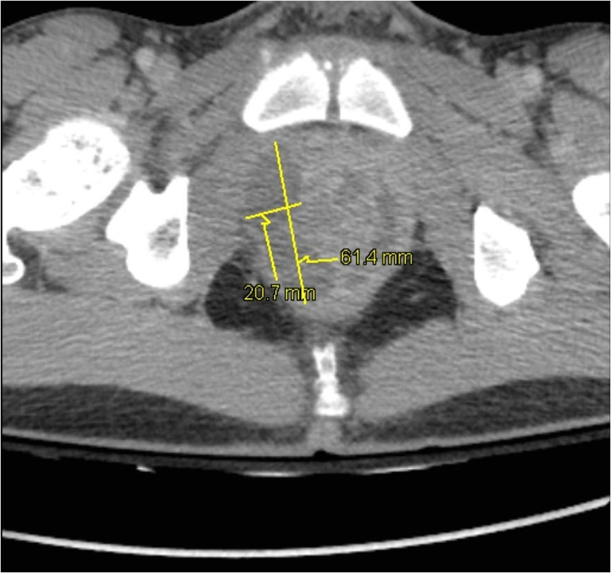 Pelvic computed tomography of prostatic abscesses