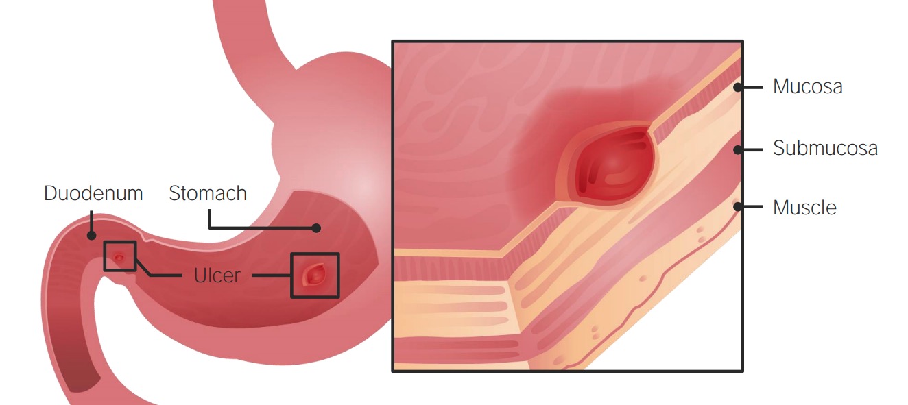 small intestine ulcer treatment