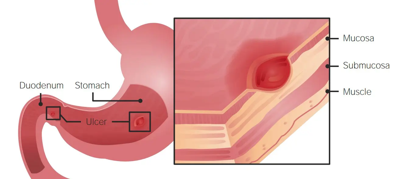 Peptic Ulcer Disease Concise Medical Knowledge