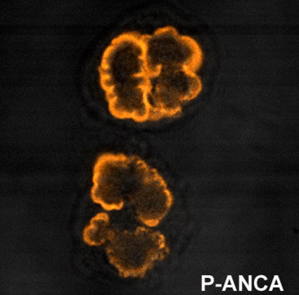 Perinuclear pattern of staining of mpo anca (p-anca)