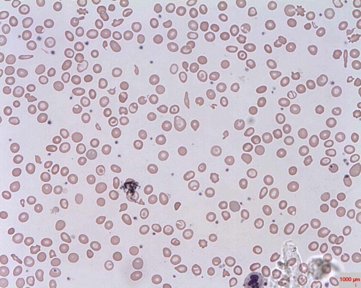 Peripheral smear microcytic, hypochromia anemia