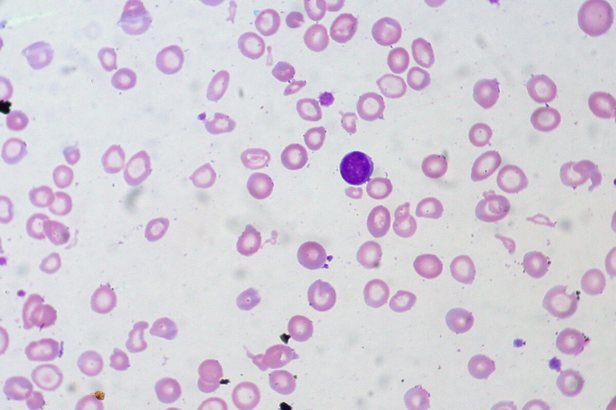 O esfregaço de sangue periférico mostra células microcíticas hipocrómicas