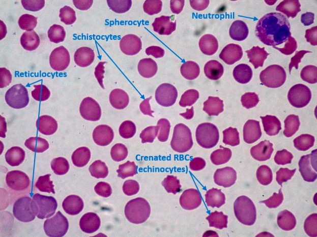 Peripheral blood film in a patient with dic demonstrating thrombocytopenia, schistocytes, and spherocytes